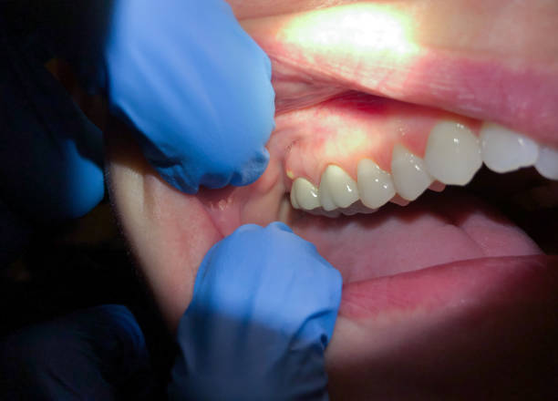 Best Chipped Tooth Repair Near Me  in Yukon, OK